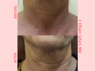 Non-surgical neck lift, skin tightening and rejuvenation with Ultherapy