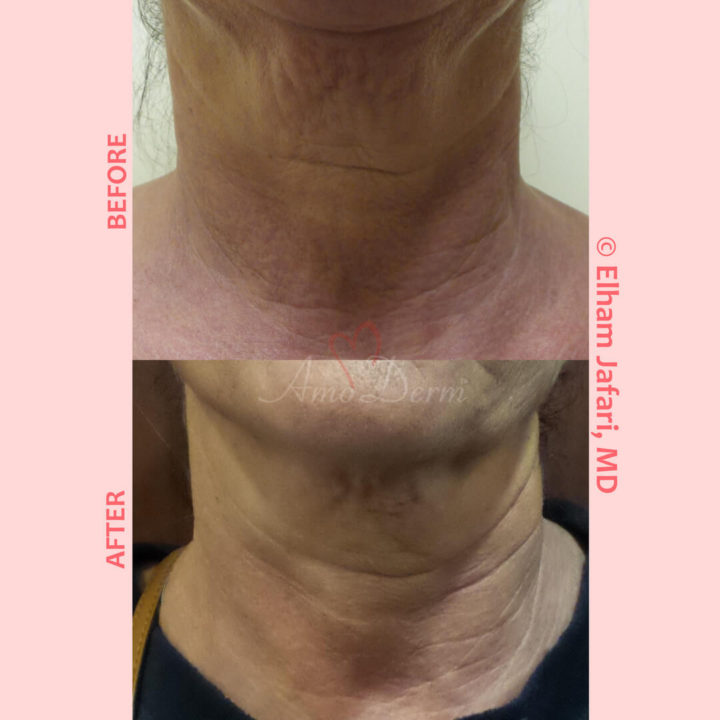 Non-surgical neck lift, skin tightening and rejuvenation with Ultherapy