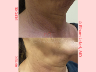 Non-surgical neck lift, skin tightening and rejuvenation with Ultherapy