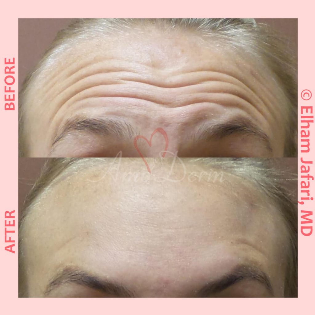 Treatment of lines and wrinkles in forehead, glabella, frown lines &amp; crows feet