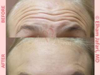 Treatment of lines and wrinkles in forehead, glabella, frown lines &amp; crows feet