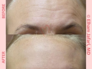 Treatment of lines and wrinkles in forehead, glabella, frown lines &amp; crows feet
