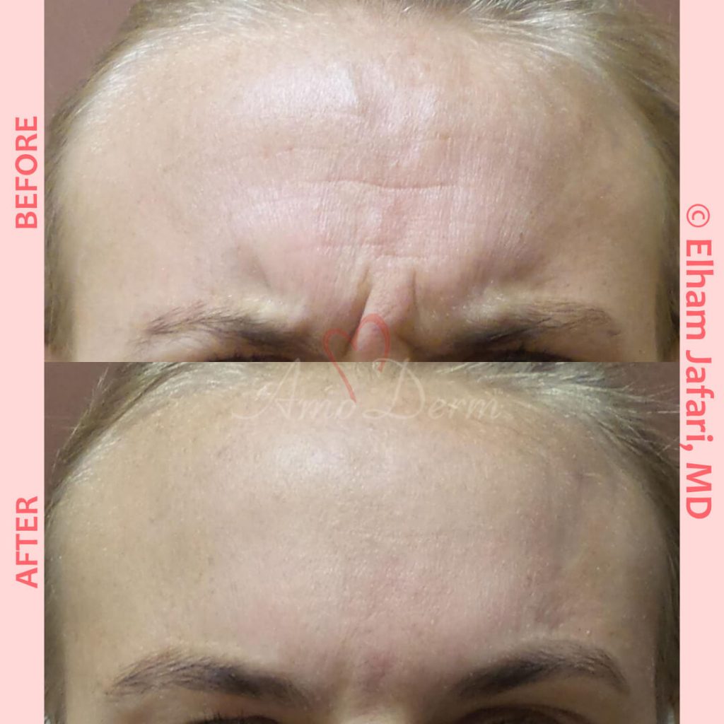 Treatment of lines and wrinkles in forehead, glabella, frown lines &amp; crows feet