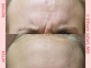 Treatment of lines and wrinkles in forehead, glabella, frown lines &amp; crows feet