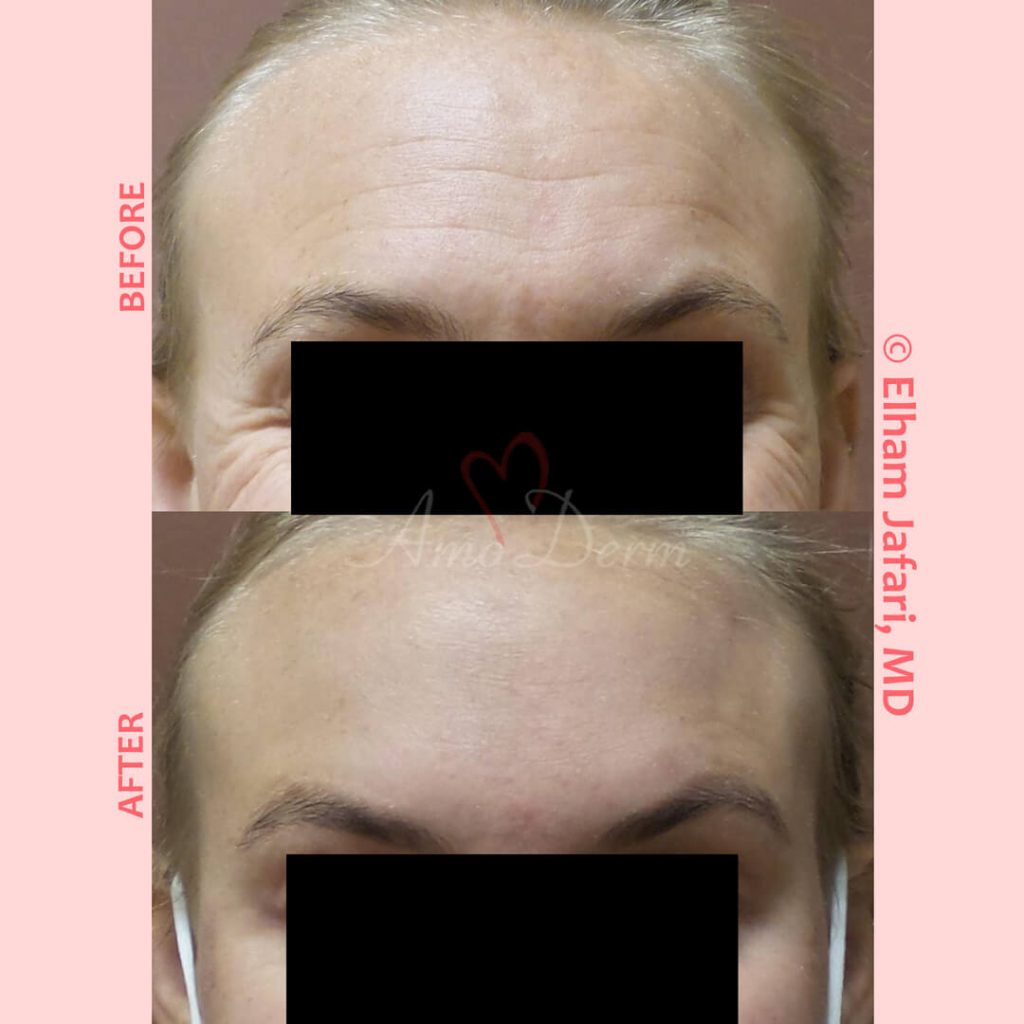 Treatment of lines and wrinkles in forehead, glabella, frown lines &amp; crows feet