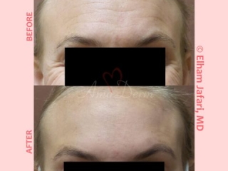 Treatment of lines and wrinkles in forehead, glabella, frown lines &amp; crows feet