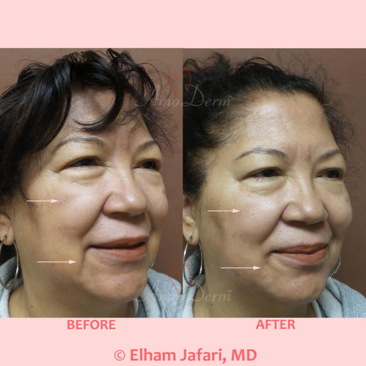 Cheek restoration & treatment of marionette lines with Juvederm, Radiesse, Vollure, Restylane or Bellafill injected with cannula