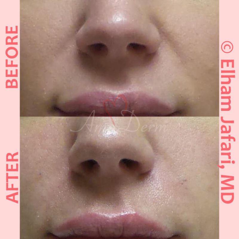 Treatment of nasolabial folds as part of non-surgical facelift