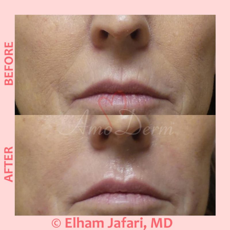 Treatment of nasolabial folds as part of non-surgical facelift