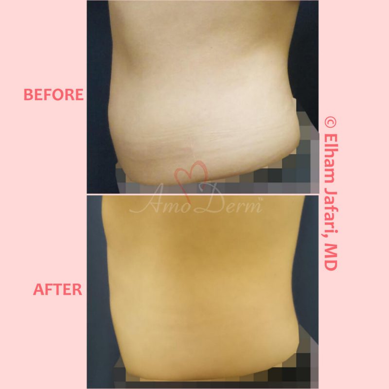 SculpSure Stubborn Fat Reduction