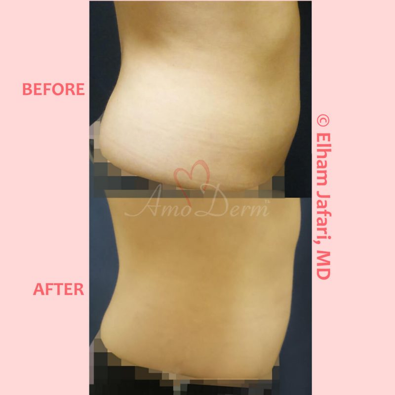 SculpSure Stubborn Fat Reduction