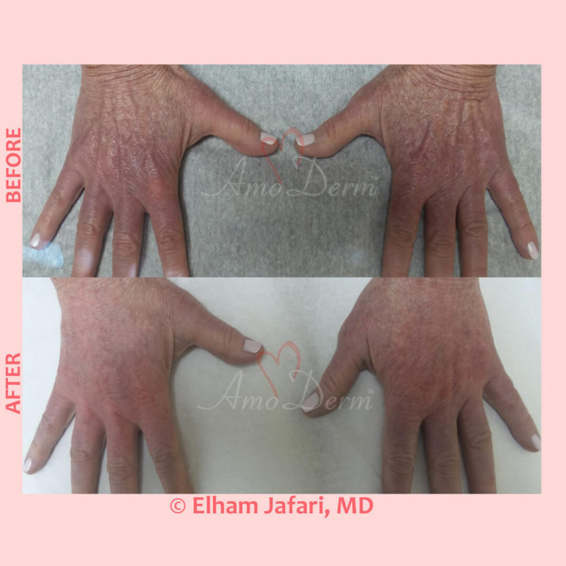 Hand rejuvenation with dermal filler injection