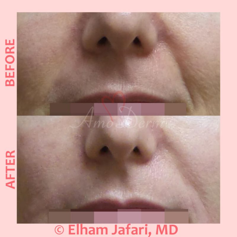 Treatment of nasolabial folds as part of non-surgical facelift