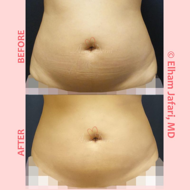 SculpSure Stubborn Fat Reduction