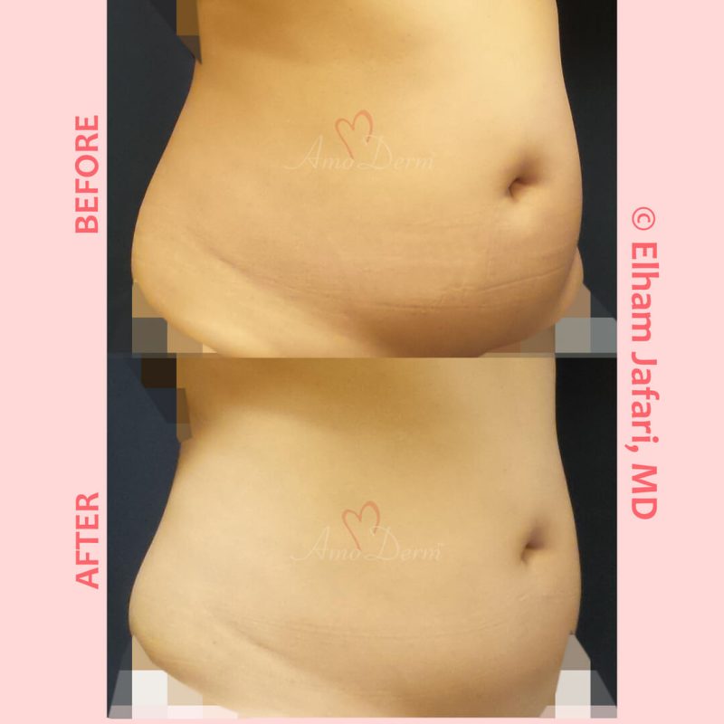 SculpSure Stubborn Fat Reduction