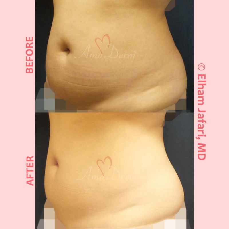 SculpSure Stubborn Fat Reduction