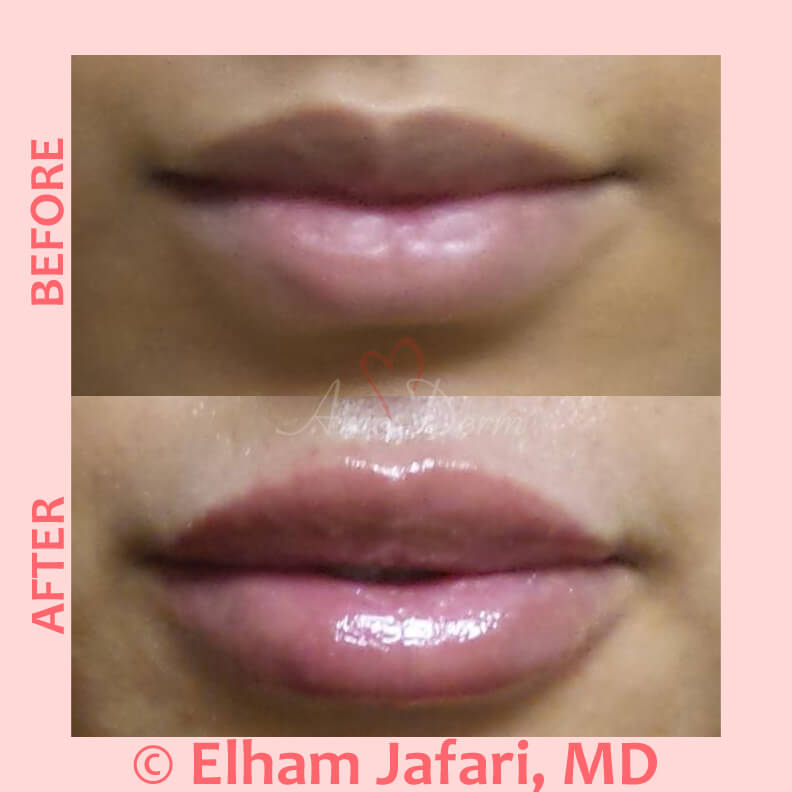 tiny-white-spots-on-lips-after-filler-lipstutorial