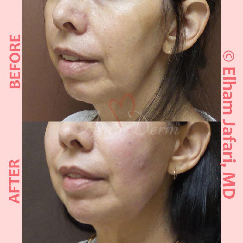 Non-surgical chin augmentation and Jawline contouring and restoration with fillers