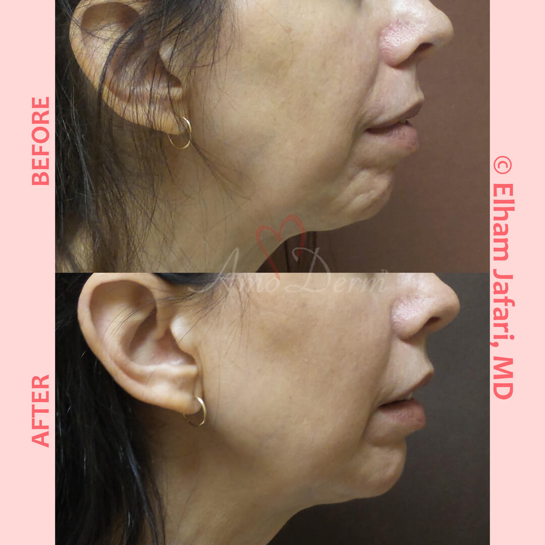 Jaw Sculpting Common Concerns and Cosmetic Procedures