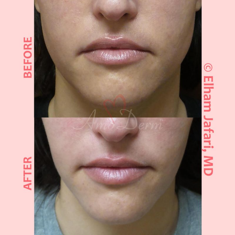 Jaw slimming with Botox, Dysport, Jeuveau or Xeomin injection into masseter muscle