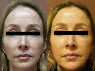 Liquid Facelift with filler injection in temples, cheeks and nose &amp; Botox between eyebrows, crow's feet, forehead &amp; upper lip