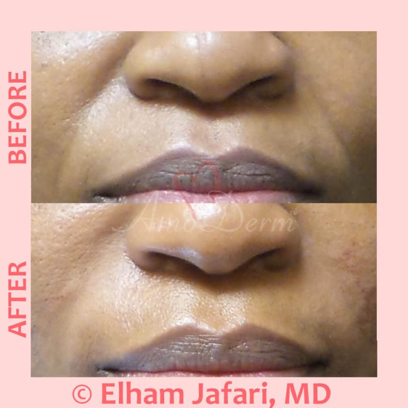 Treatment of nasolabial folds as part of non-surgical facelift
