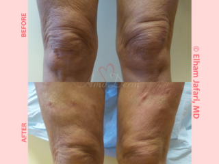 PDO Thread Lift for non-surgical knee cap lift