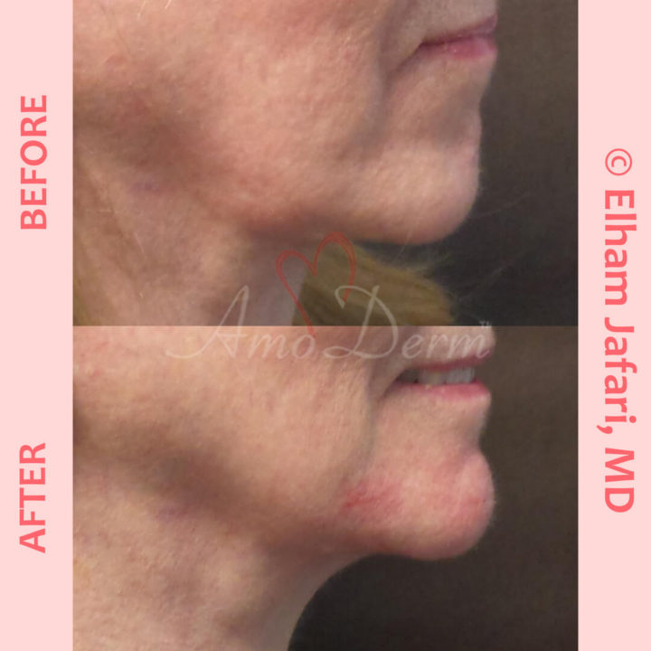 Non-surgical chin augmentation and Jawline contouring and restoration with fillers
