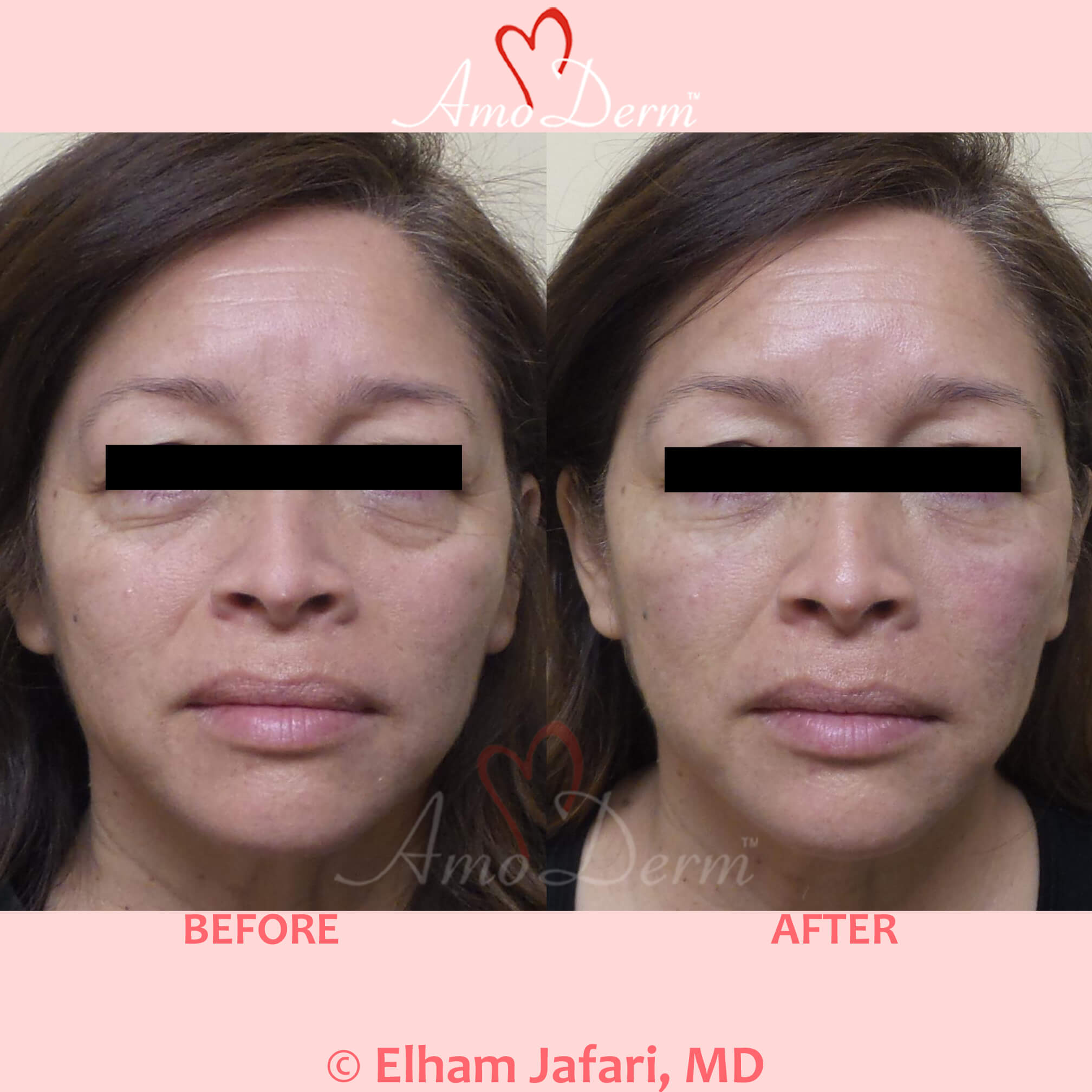 4D Under Eye Lift to treat dark circles under eyes & contour cheeks
