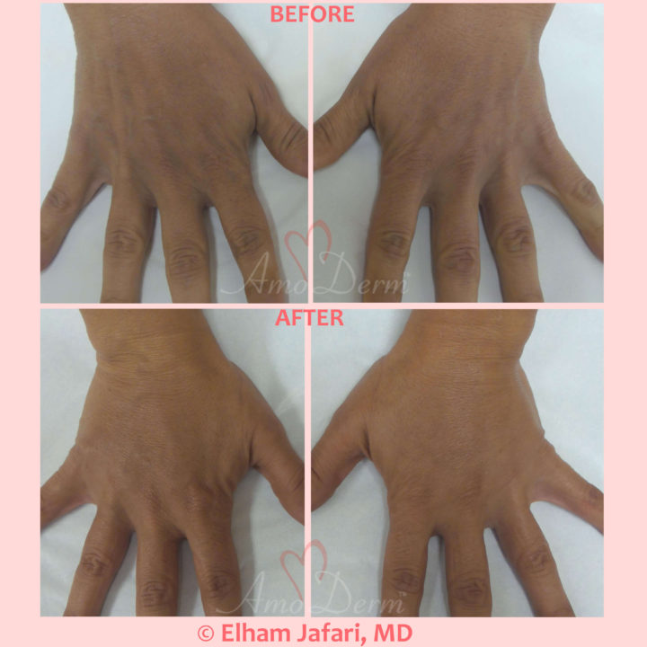 Hand rejuvenation with dermal filler injection