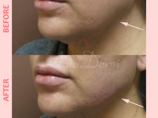 Filler and PDO thread lift for jawline