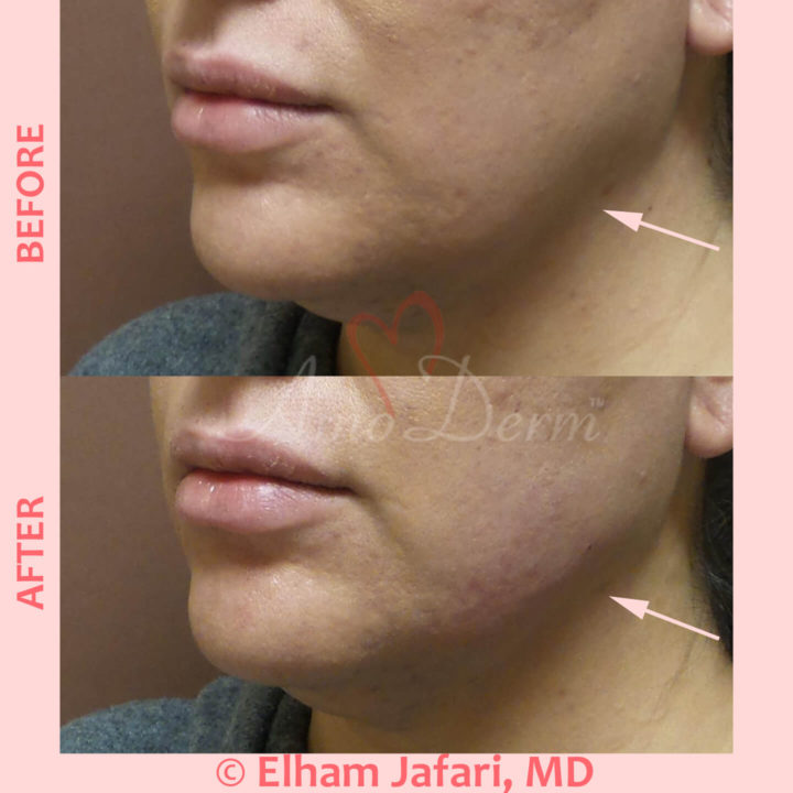 Filler and PDO thread lift for jawline