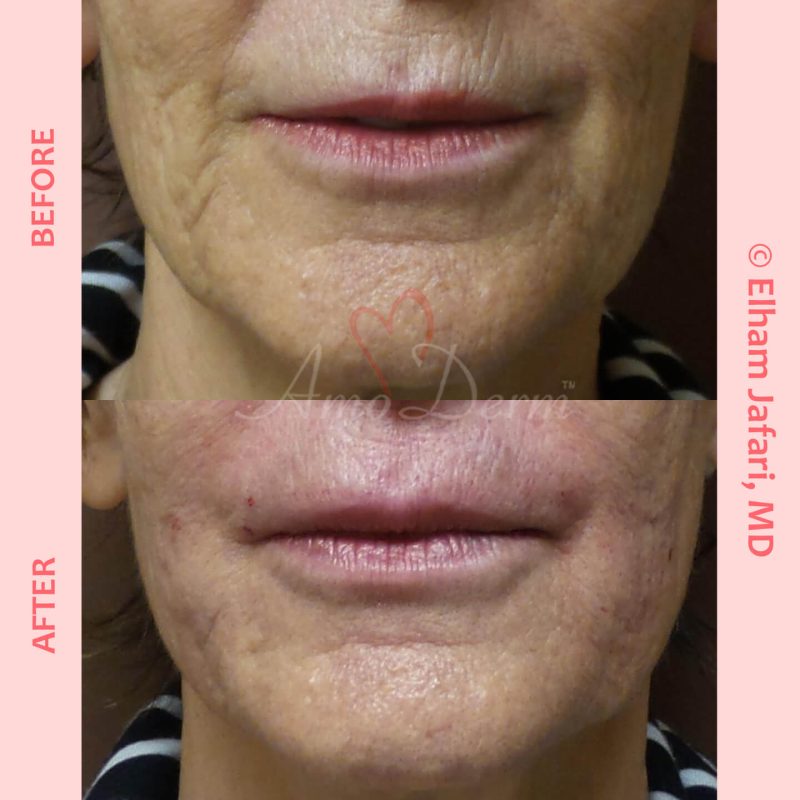 Treatment of marionette lines, nasolabial folds and upper lip lines with Juvederm, Vollure, Restylane or Bellafill injected with cannula