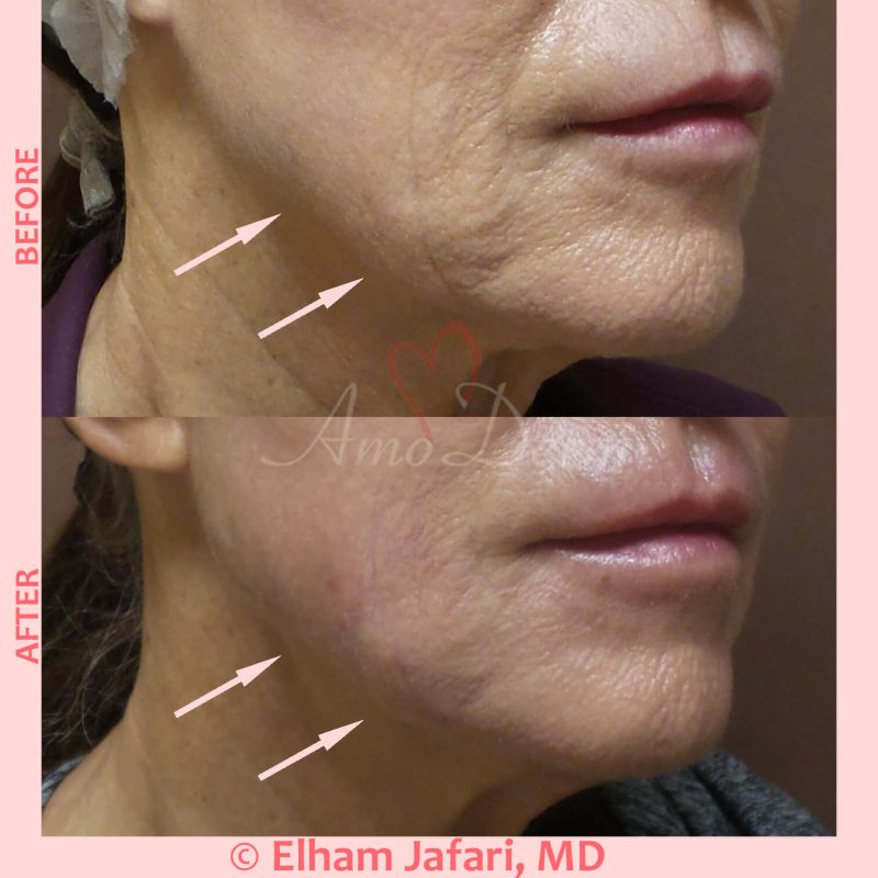 Jawline contouring and restoration with fillers