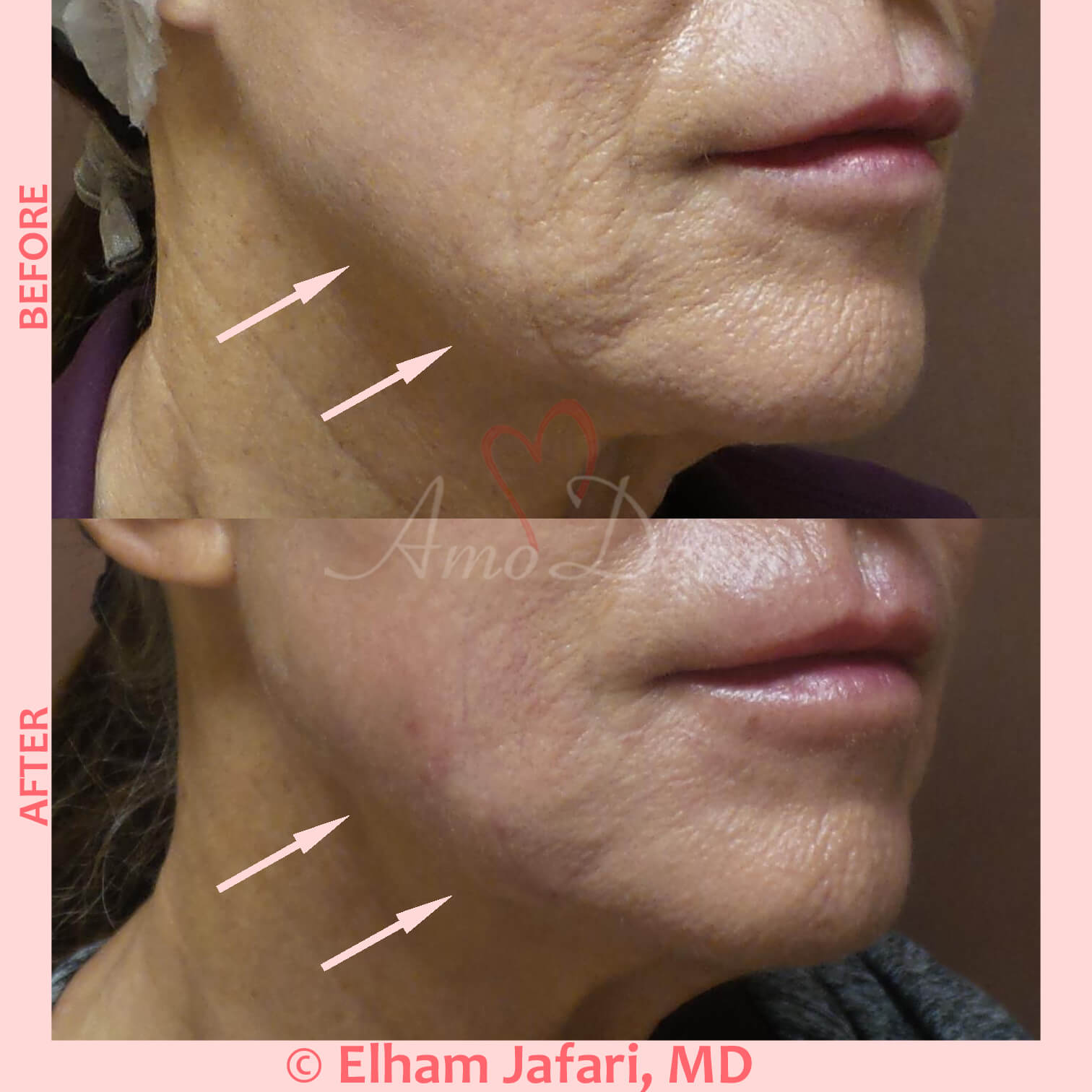 Jaw Sculpting Common Concerns and Cosmetic Procedures