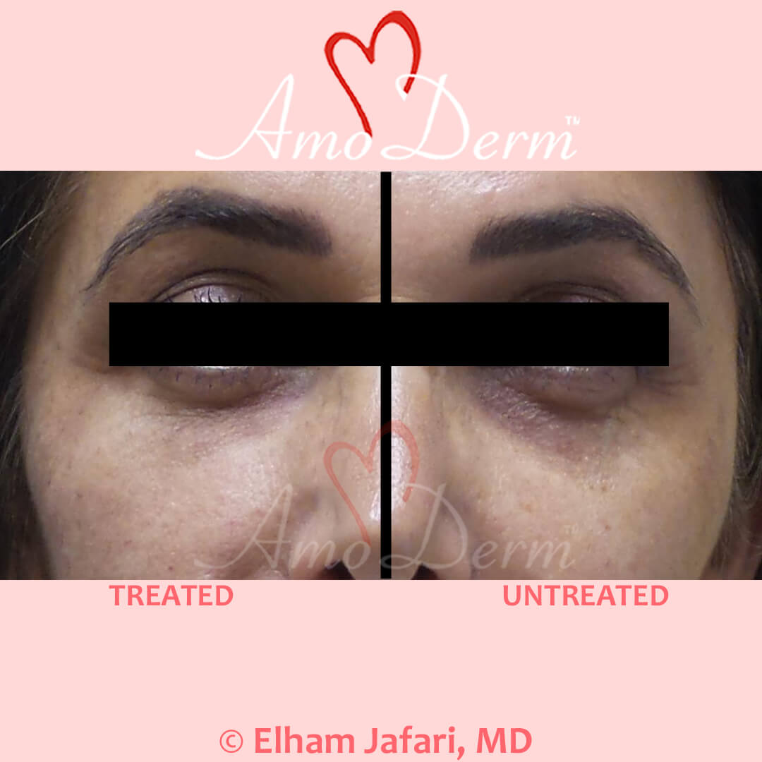 download dark circles under eyes treatment download dark circles under eyes treatment
