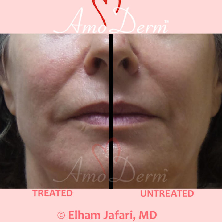 Liquid Facelift with PDO Thread in mid and lower face and around the mouth