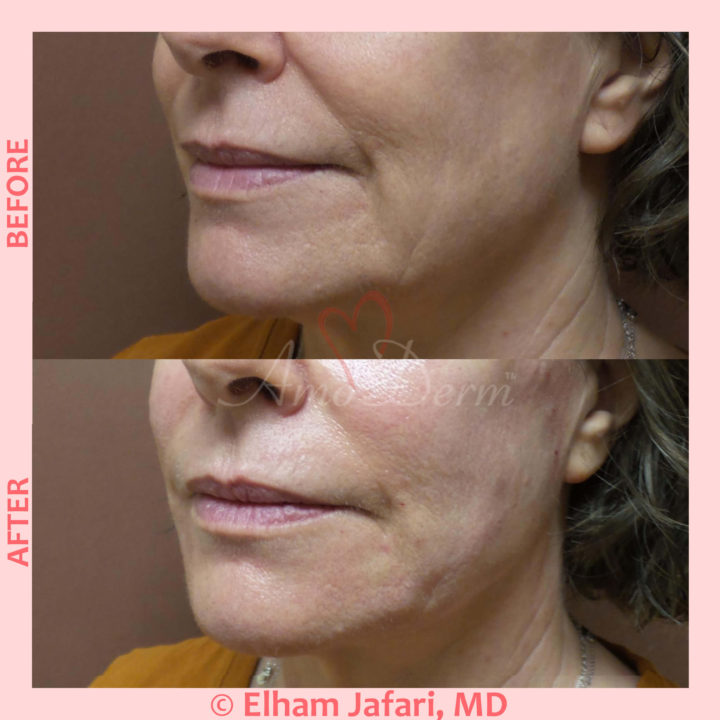 Liquid Facelift with PDO Thread in mid and lower face and around the mouth