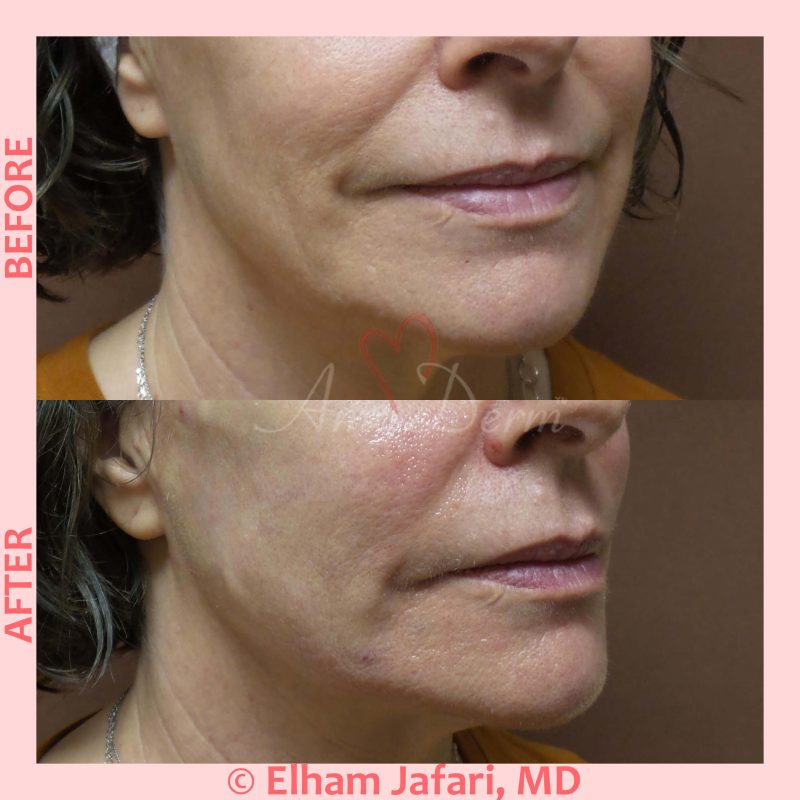 Liquid Facelift with PDO Thread in mid and lower face and around the mouth
