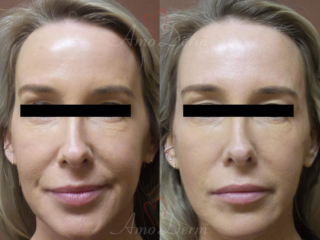 Liquid Facelift with filler injection in the temples