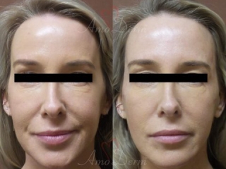 Liquid Facelift with filler injection in the temples