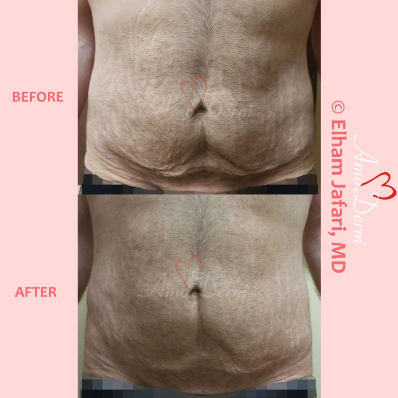 Skin tightening, body sculpting and body contouring with Venus Freeze (radiofrequency) in abdomen