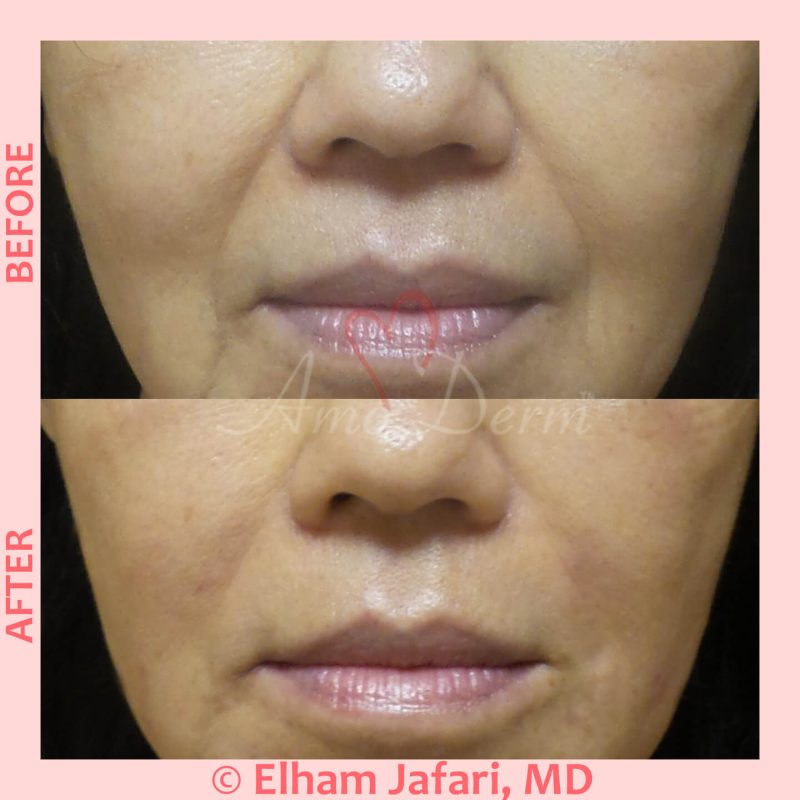 Treatment of nasolabial folds