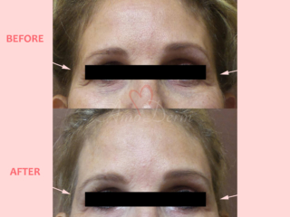 Volume restoration in temples with filler injection (Juvederm, Restylane, Voluma, Sculptra)