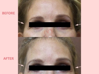 Volume restoration in temples with filler injection (Juvederm, Restylane, Voluma, Sculptra)