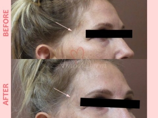 Volume restoration in temples with filler injection (Juvederm, Restylane, Voluma, Sculptra)