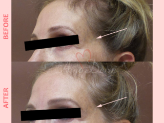 Volume restoration in temples with filler injection (Juvederm, Restylane, Voluma, Sculptra)