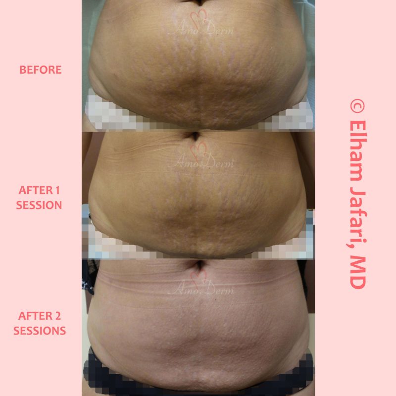 SculpSure Stubborn Fat Reduction