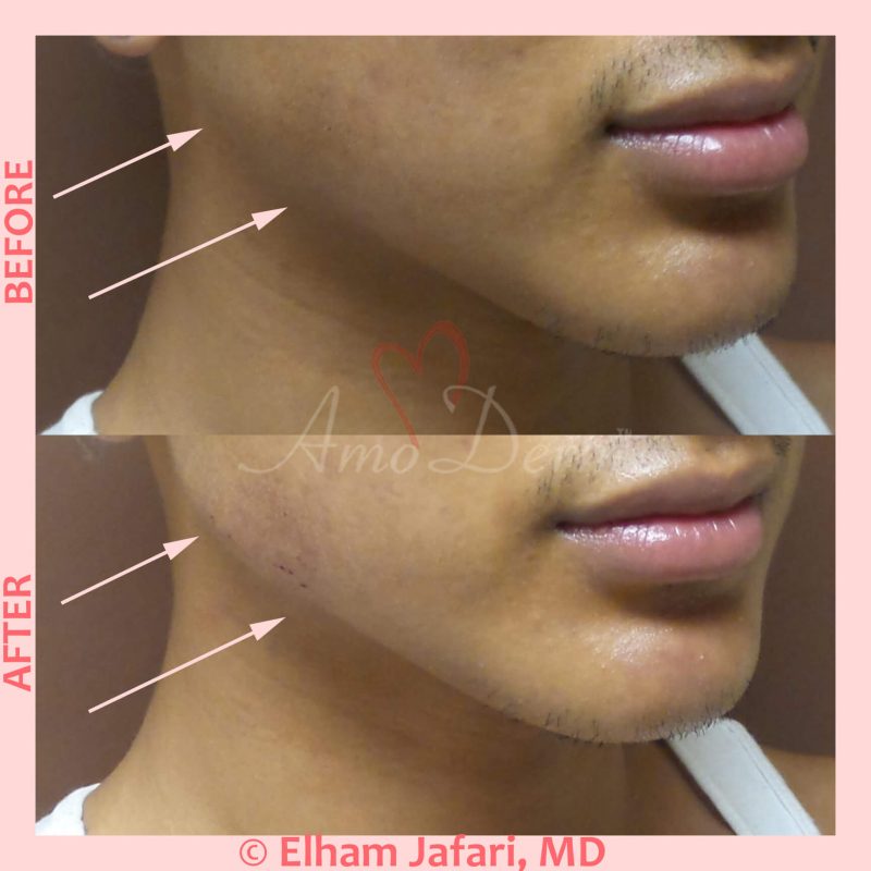 Jawline contouring and restoration with fillers