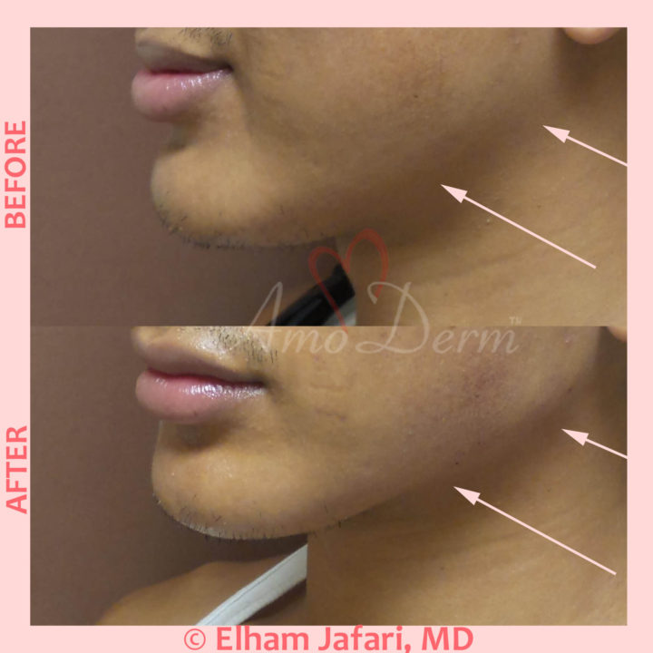 Jaw Sculpting Common Concerns and Cosmetic Procedures